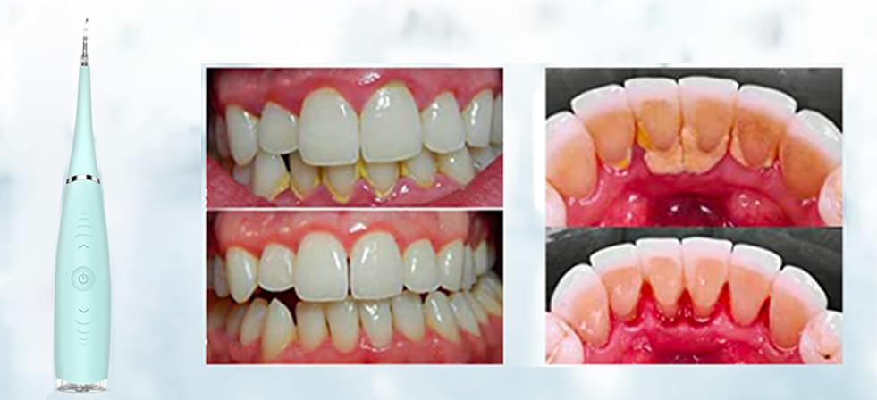 Bbryance V3 Kit Himent Dentaire